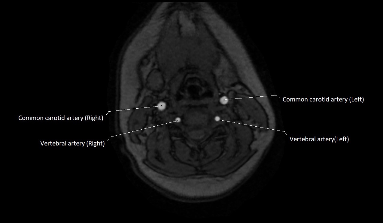 Carotid artery anatomy axial 3T image 32.jpg